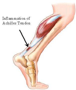 La tendinitis no es más que la inflamación de un tendón, lo cual produce dolor en la zona afectada.
